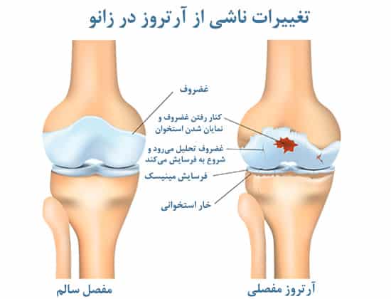 آرتروز زانو چگونه ایجاد میشود؟