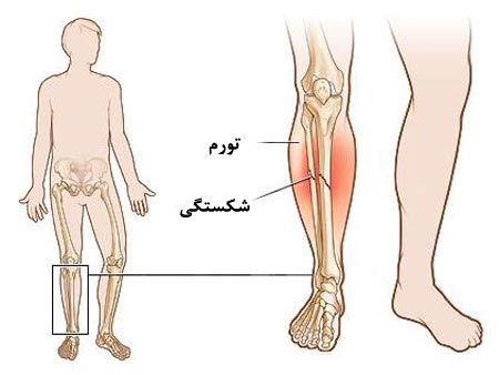 3شکستگی