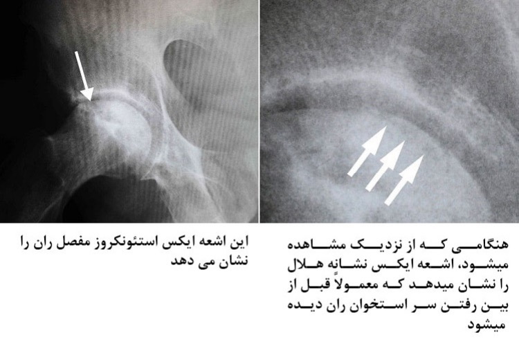 تصویربرداری برای نکروز عروقی