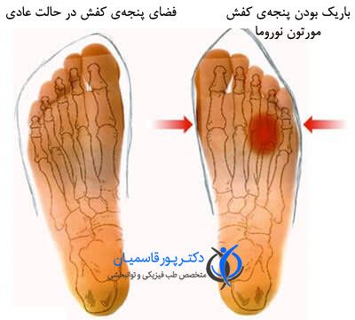 درمان مورتون نوروما با کفش طبی