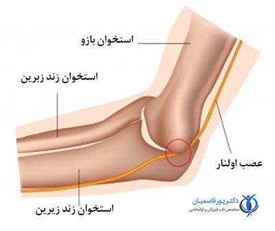 سندرم تونل کوبیتال آرنج