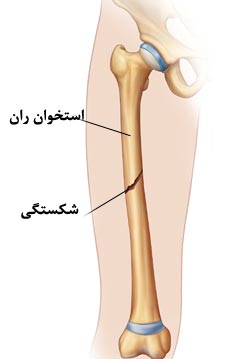 شکستگی1