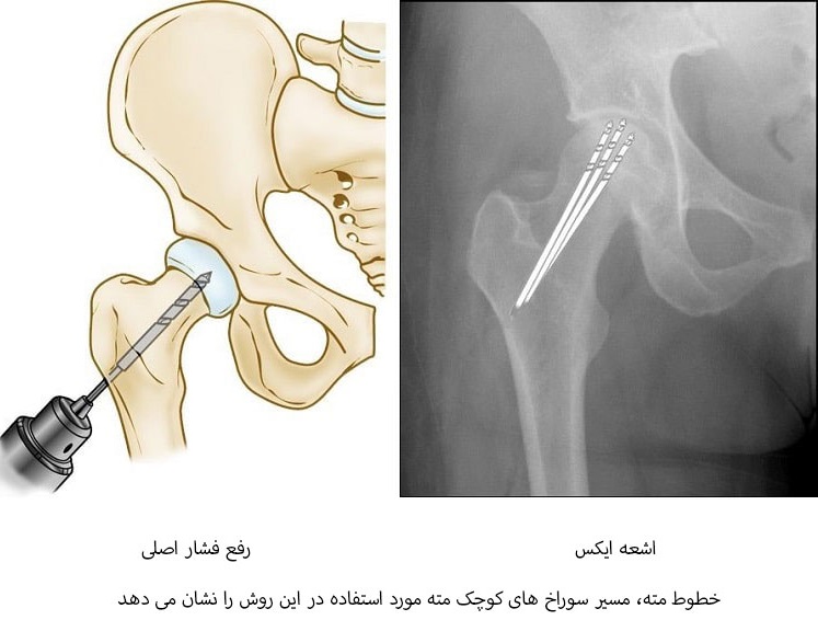 فشرده سازی مغزی برای نکروز عروقی